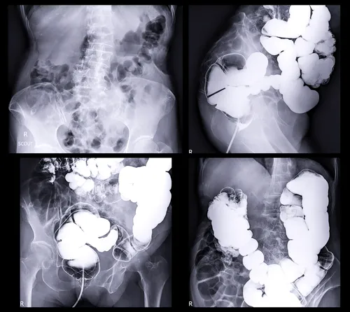 El cáncer colorrectal es el tipo de cáncer que más muertes está causando en personas menores de 50 años